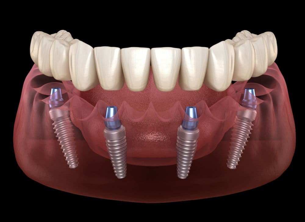 All-on-4 full-arch dental implant illustration in Tribeca NYC