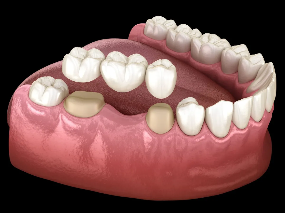 Dental crowns and bridges in Tribeca NYC