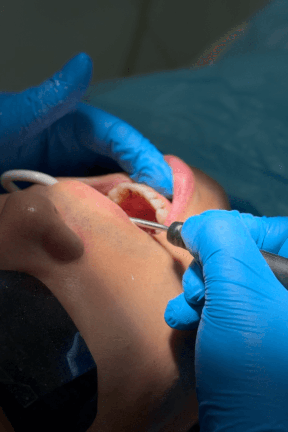 From Filling to Crown: What You Need to Know for a Stronger Smile
