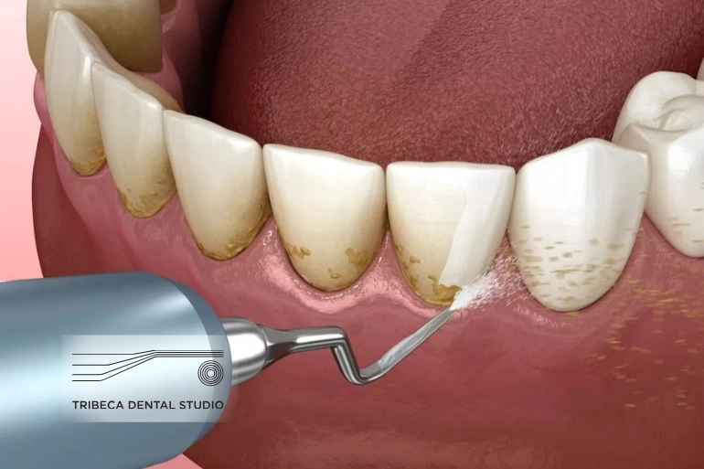 Teeth Cleaning in Tribeca