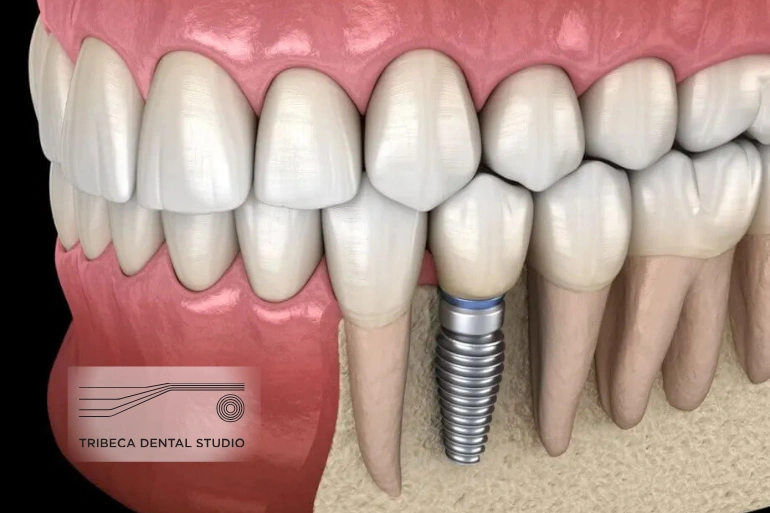 Dental Implants | Board-Certified Implant Specialist Dr. Sam