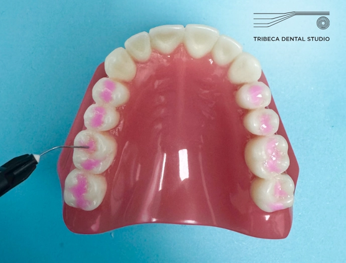 Dental Sealants In Tribeca, NYC