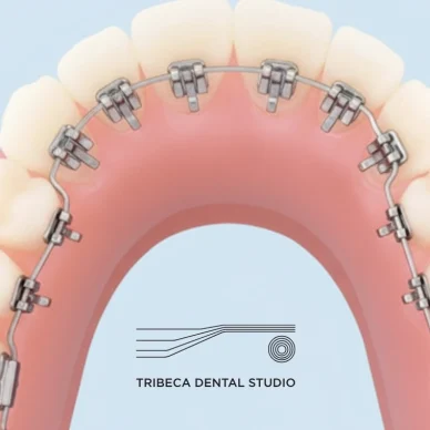 Lingual Braces In NYC