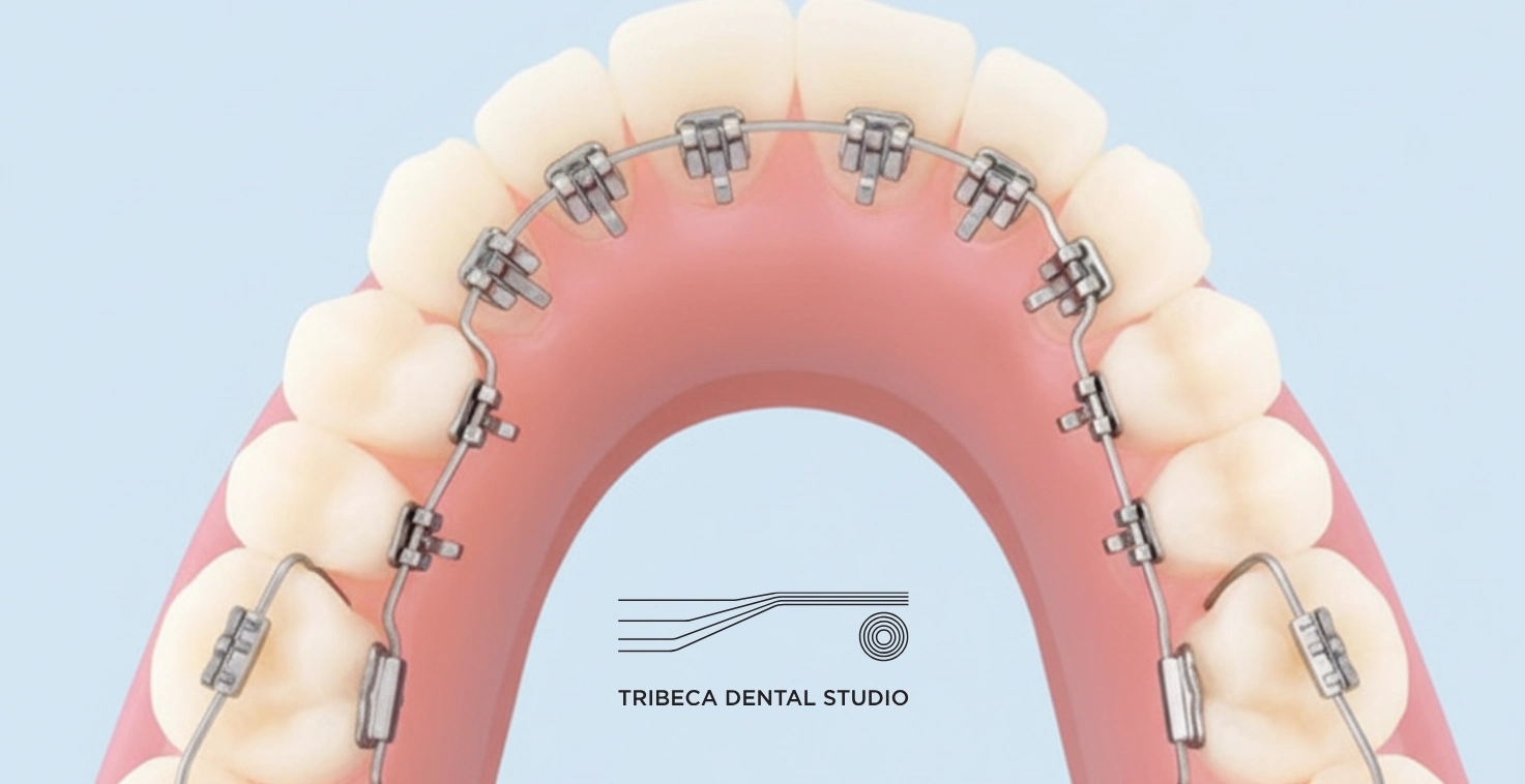 Lingual Braces In Tribeca, NYC