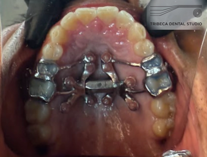 (MARPE) Palatal Expansion in NYC at Tribeca Dental Studio Airway Orthodontics