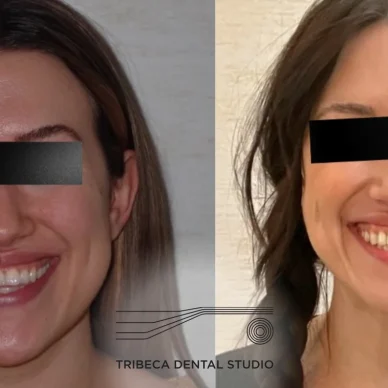 Maxillary Skeletal Expansion (MSE) In NYC For Adult