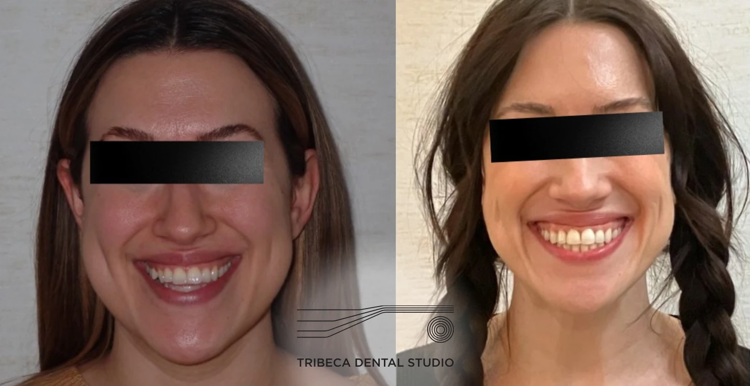 Maxillary Skeletal Expansion (MSE) In Tribeca, NYC