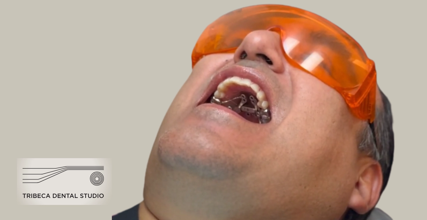 Palatal Expansion (MARPE) in Tribeca, NYC