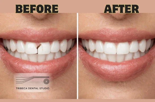 chipped front tooth repair