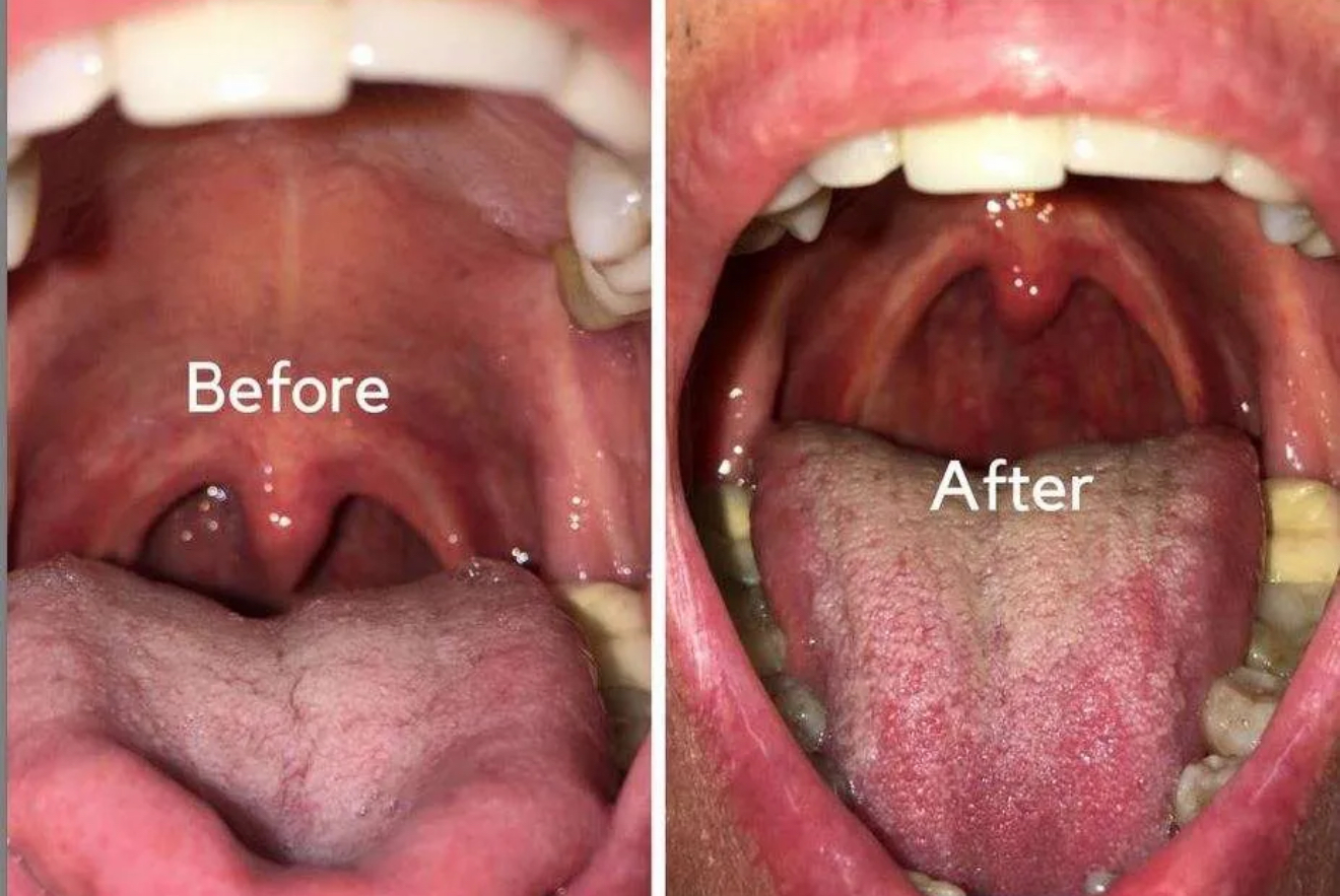 Before and After nightlase