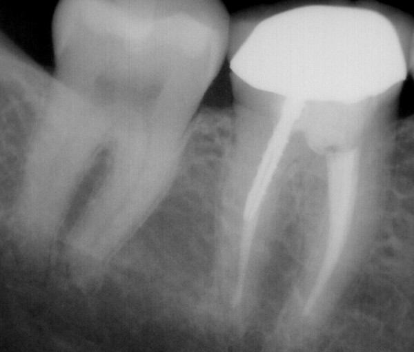 Root Canal Treatment At Tribeca Dental Studio