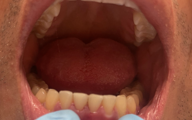 Dental Filling After at Tribeca Dental Studio