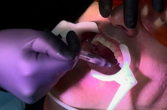 dry socket treatment NYC