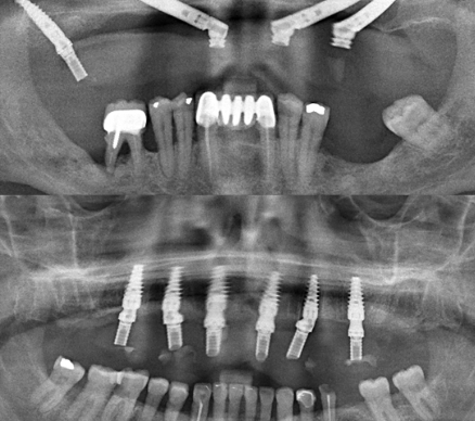 Best Dental Implants. Tribeca Dental Studio All on 6 vs Zygomatic implants