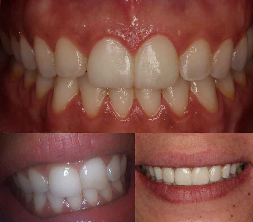 Veneers in NYC at Tribeca Dental Studio