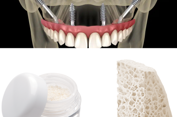 Puros bone block allograft material used for severe jaw bone reconstruction at Tribeca Dental Studio NYC