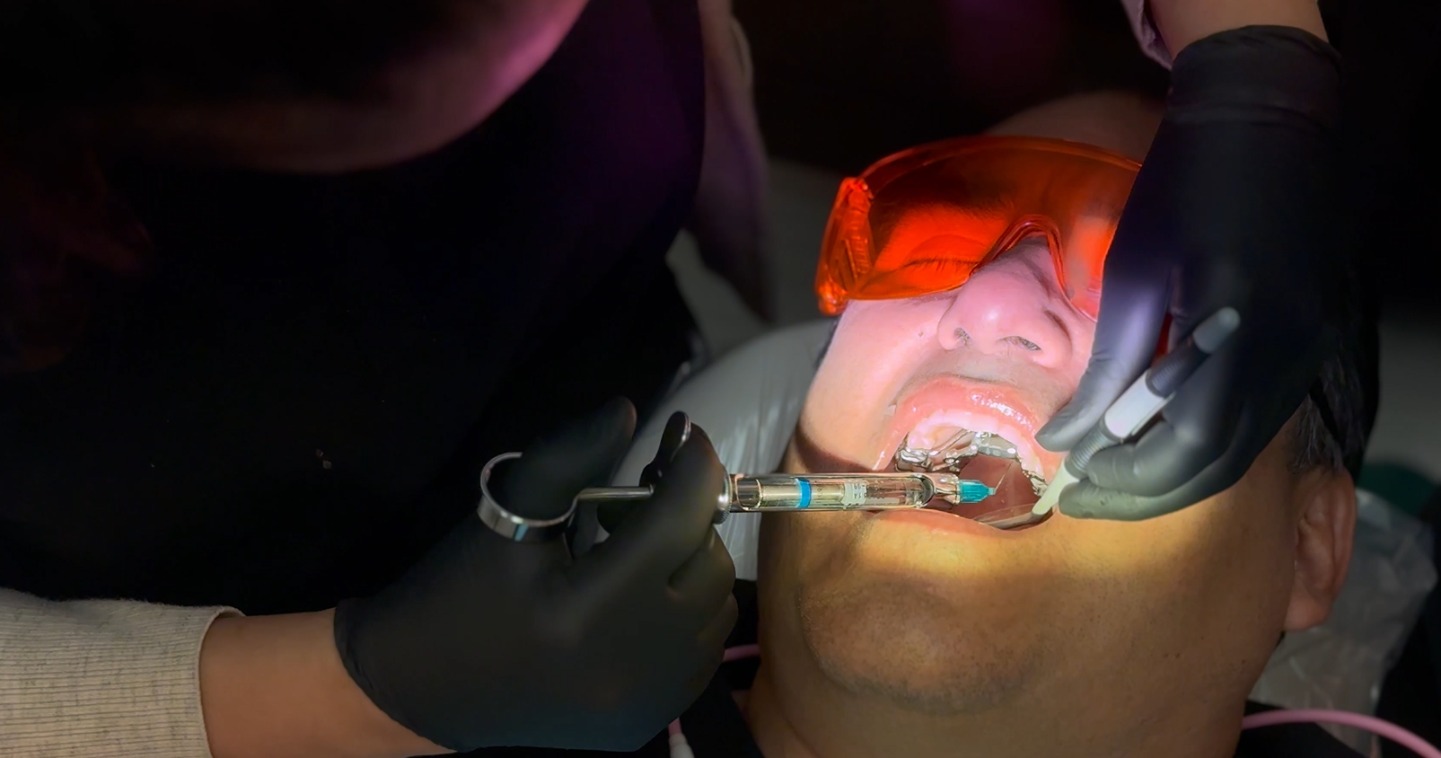 what to expect when getting a filling