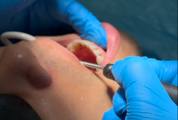 early gum disease signs deep cleaning