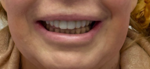 confident smile after missing tooth restoration