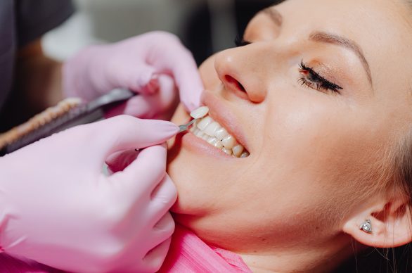 bonding chipped tooth